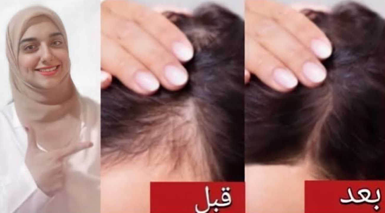 لو شعرك بيوقع تعالي.. وصفة سحرية للتخلص من تساقط الشعر في اسبوع واحد