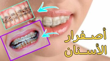 أسباب اصفرار الأسنان وطرق التخلص من الإصفرار