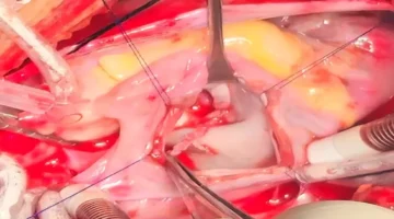 جراحو قصر العيني ينجحون في استئصال ورم قلب طفل دون مساس بالصمام