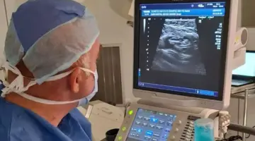 نجاح علاج ورم ليفي بالقسطرة عوض الجراحة بجامعة العاصمة